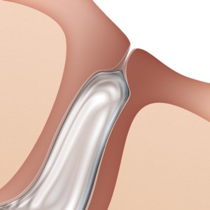 Oasis FORM FIT Intracanalicular Plugs