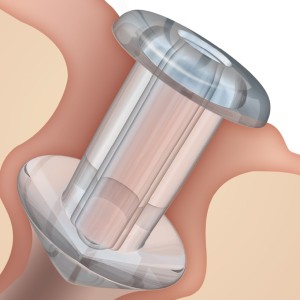 SOFT PLUG Preloaded Silicone Punctum Plugs (2-pk)