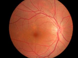Retinal Cameras